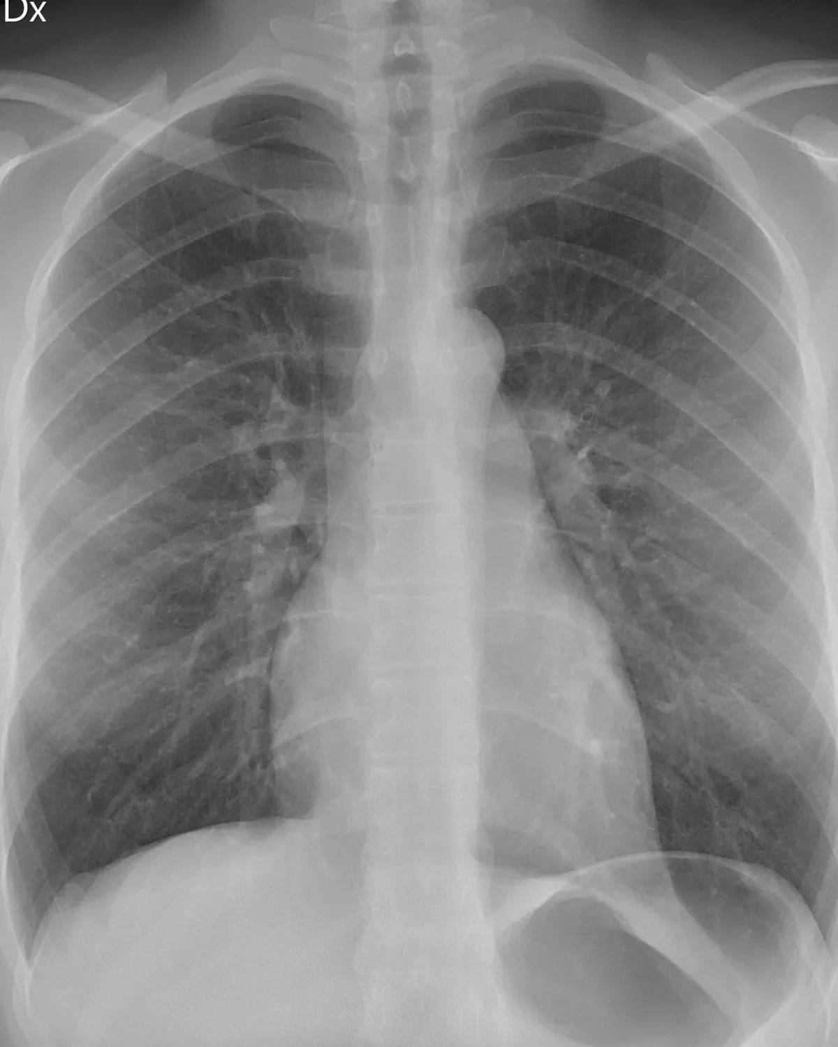 A black and white chest X-ray, front view